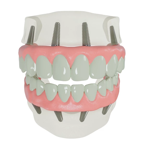 How Do All-on-4 Dental Implants