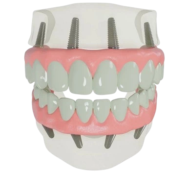 What Are All-on-4 Dental Implants