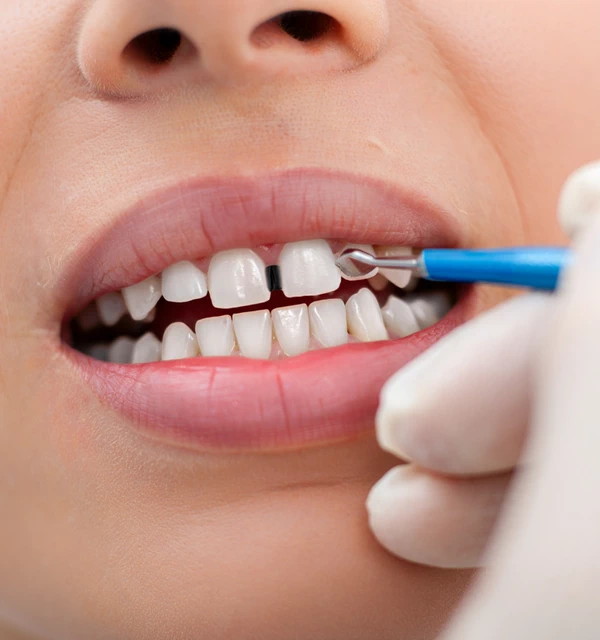 What is cosmetic dental bonding