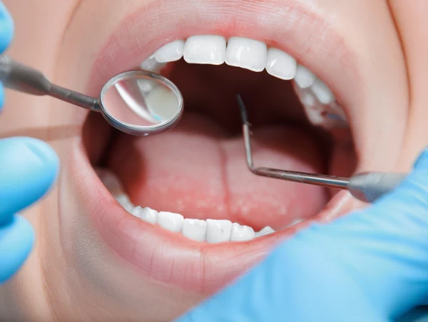 Having a composite filling is easy