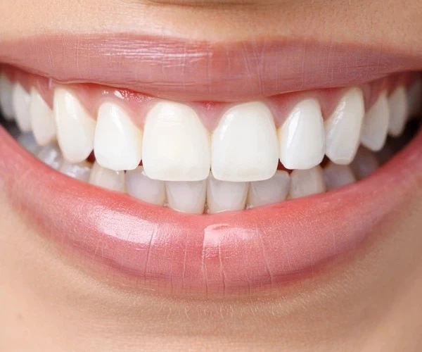 Benefits Of dental bonding