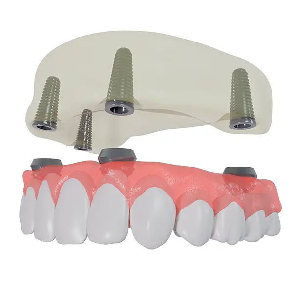 All-on-4 dental implants