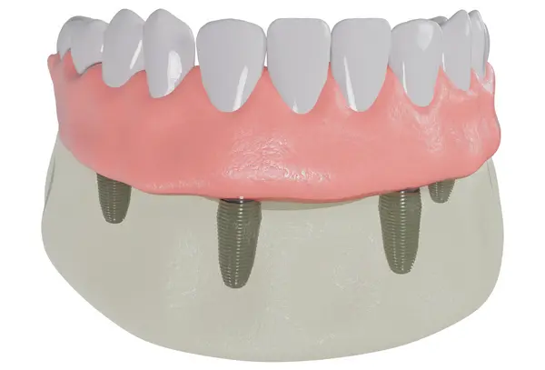 All-on-4 uses just four ingeniously designed supports to carry an entire arch of teeth